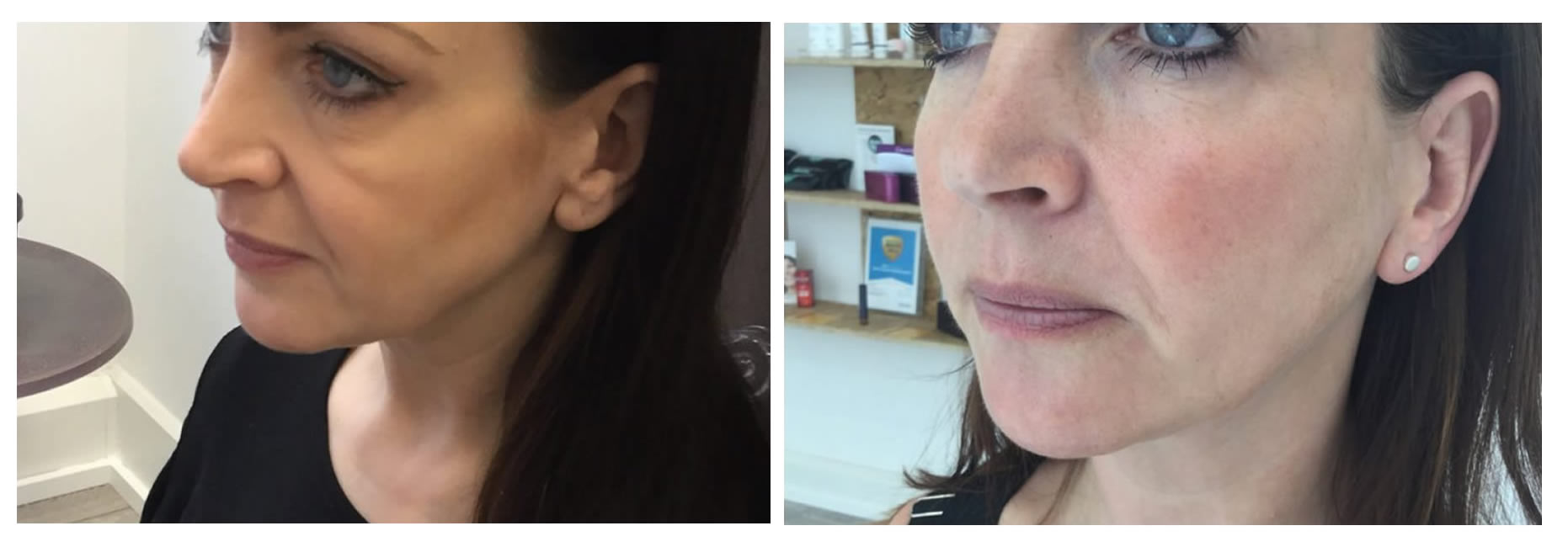 face contouring before and after 4