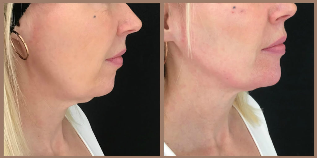 jaw fillers before and after