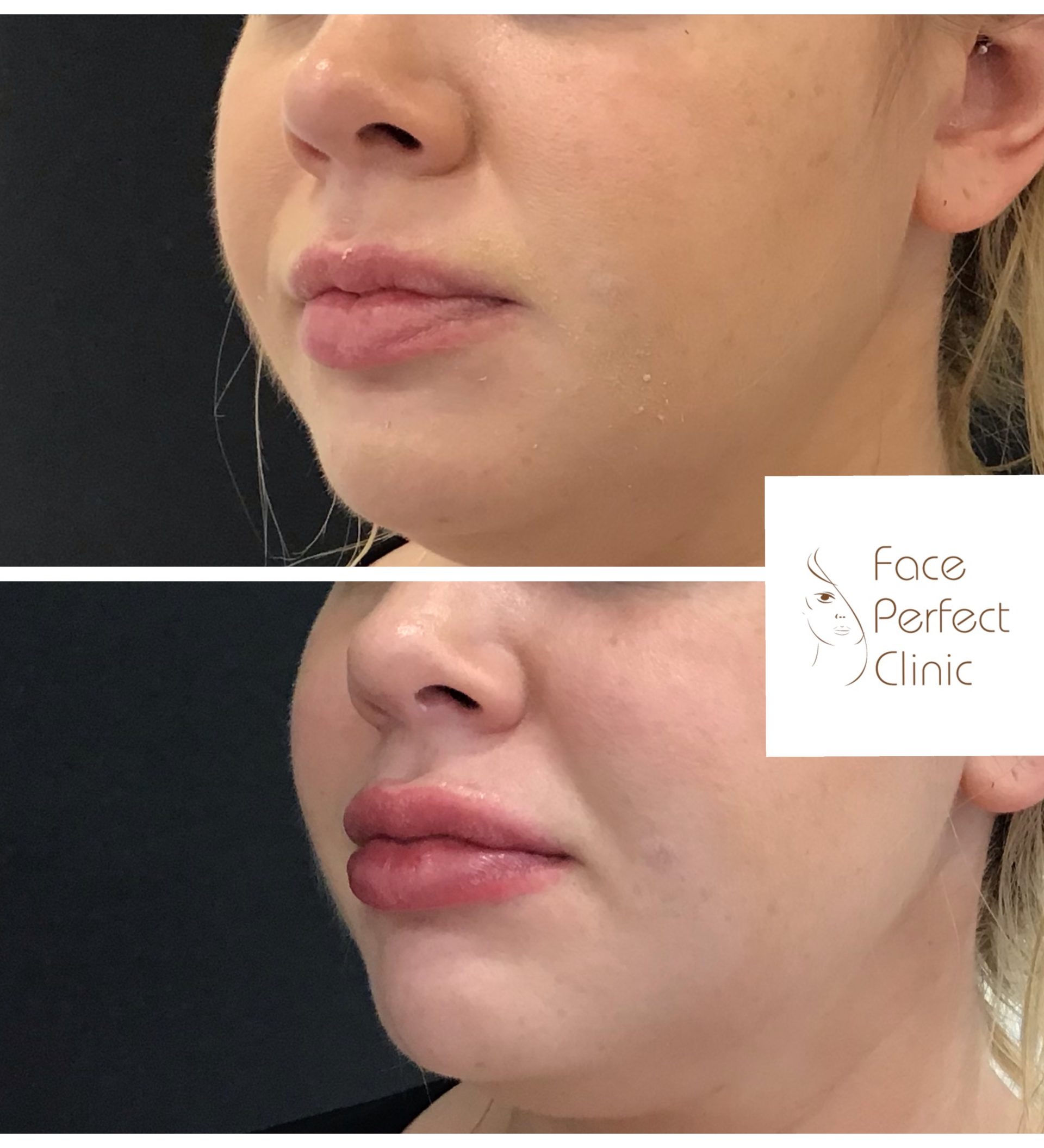 Dermal Lip Fillers Leeds Lip Augmentation Face Perfect Clinic