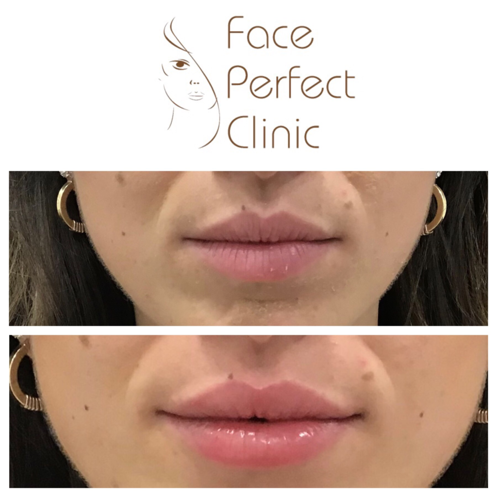 Dermal Lip Fillers Leeds Lip Augmentation Face Perfect Clinic