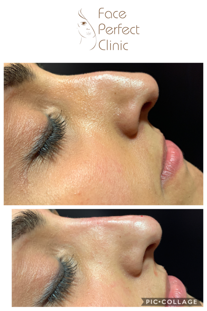 non surgical rhinoplasty before and after