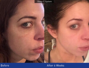 obagi-skincare-before-after