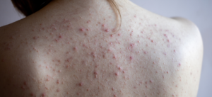 back-acne-hydrafacial-treatment