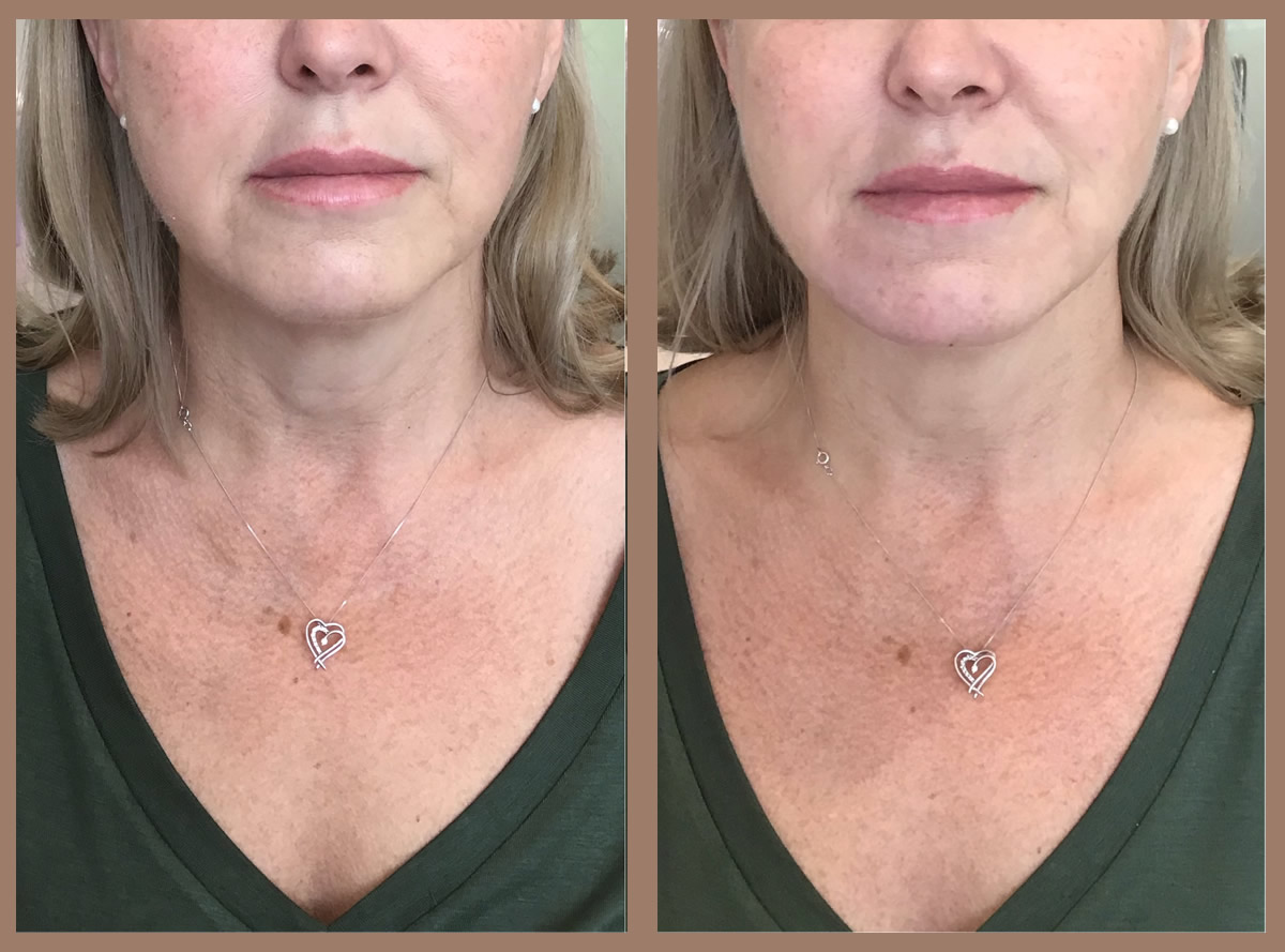 Advanced Jawline Fillers Leeds Juvederm Volux Face Perfect Clinic