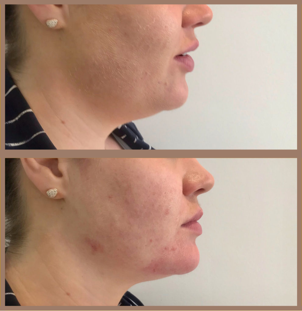 juvederm volux before and after 