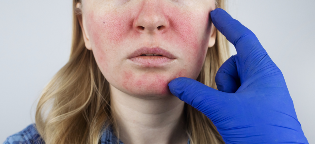 Rosacea Causes Symptoms Treatments Face Perfect Clinic