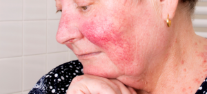 rosacea